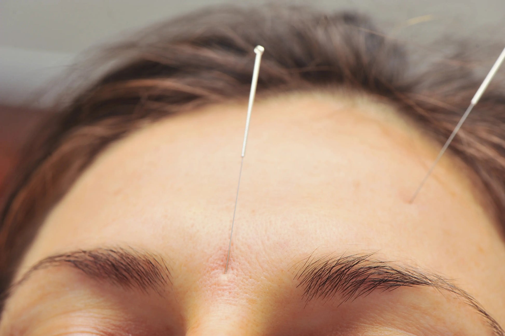 facial acupuncture manchester