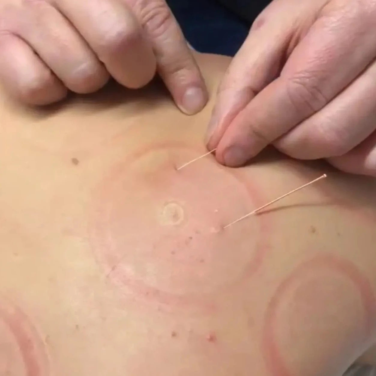 back acupuncture post cupping salford