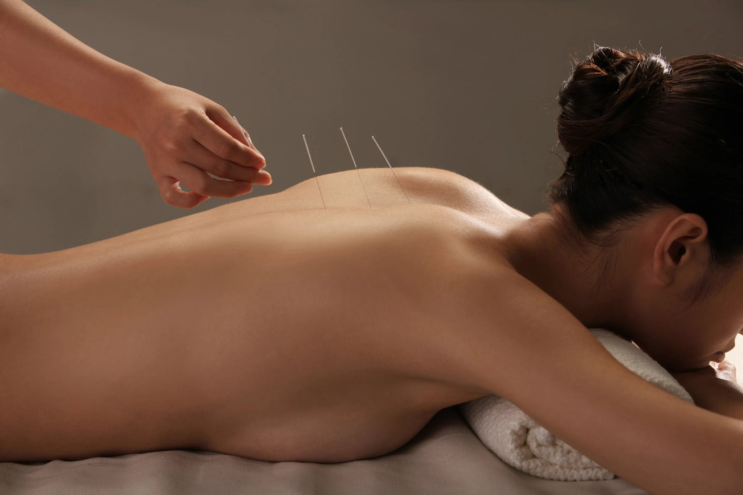 woman having back acupuncture 