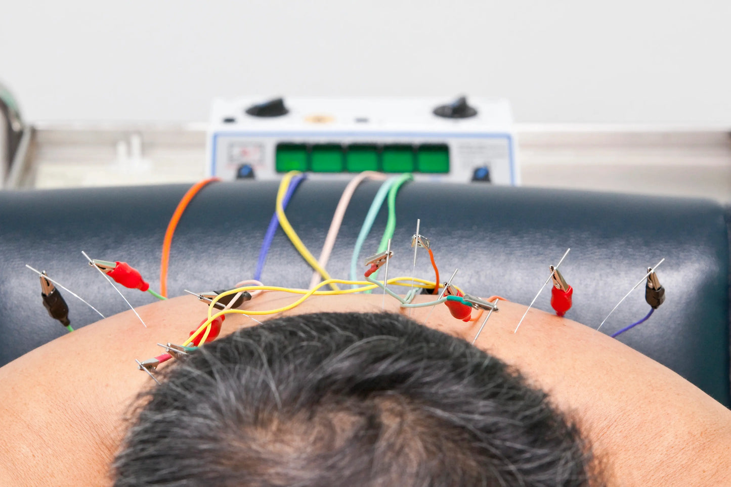 acupuncture with electro stimulation